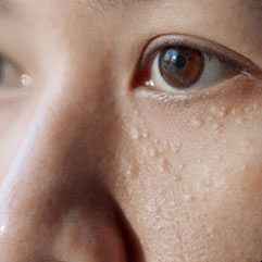 稗粒腫(はいりゅうしゅ)