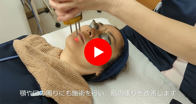 ピコレーザー施術