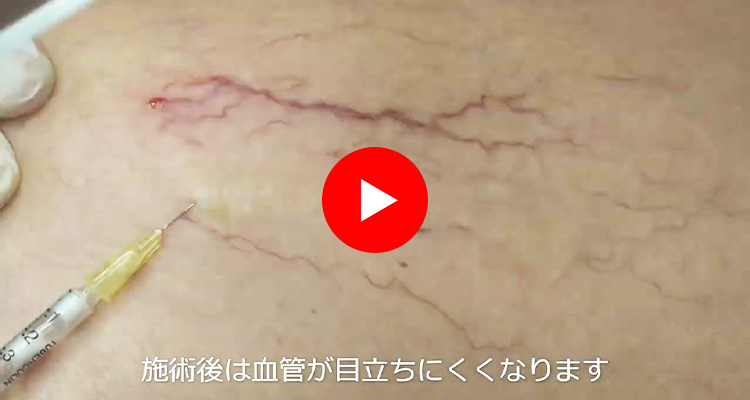 くもの巣状静脈瘤の硬化療法