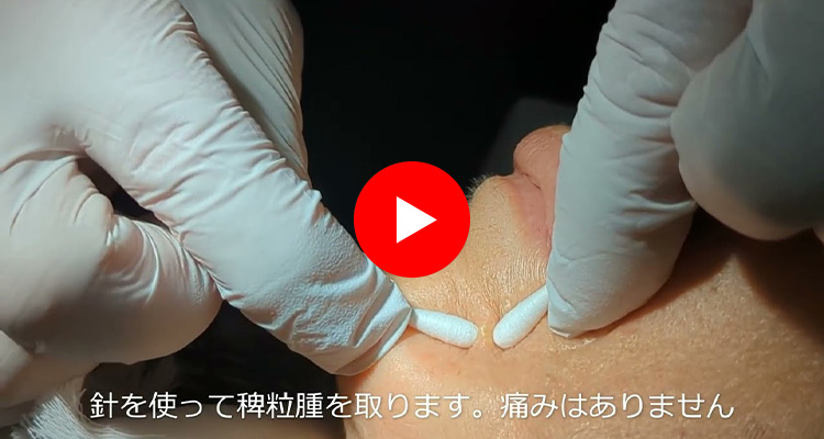 稗粒腫（はいりゅうしゅ）の治療