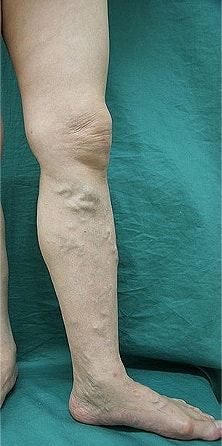 足の血管が目立つ（下肢静脈瘤）