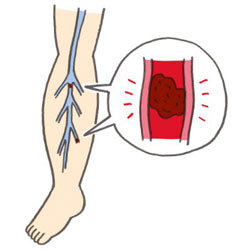 足の深部静脈に血栓が生じる