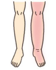 足が赤く腫れて熱感と痛みを伴う。血管が浮き出ることもある